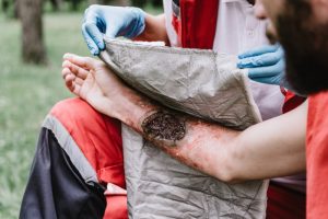 Are You Suffering From a Burn Injury?